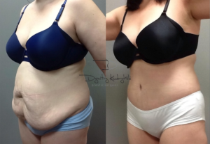 abdominoplasty1