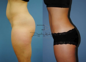 abdominoplasty2