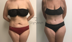 abdominoplasty4