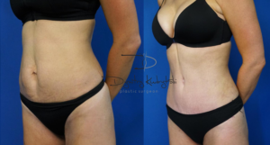 abdominoplasty7