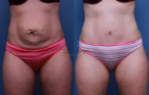 abdominoplasty8